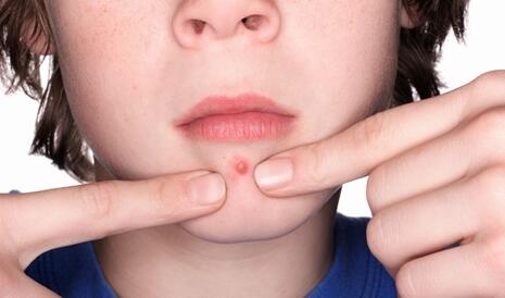 痘肌化妆有方法 痘肌化妆有方法