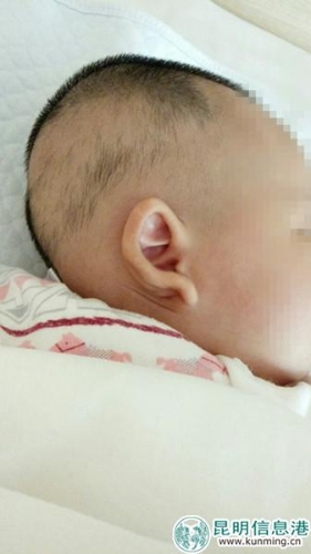 孩子右耳稍显变形。家属供图