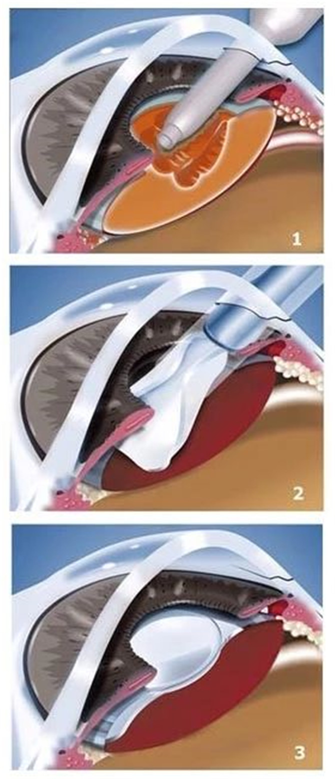 三焦点人工晶状体植入术示意图