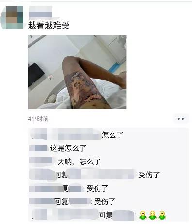 丽江一男子买了手机才6天，手机便发生爆炸烧伤大腿？