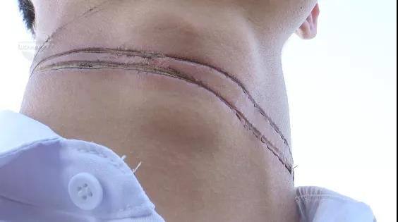 外卖小哥骑车被风筝线“割喉”!