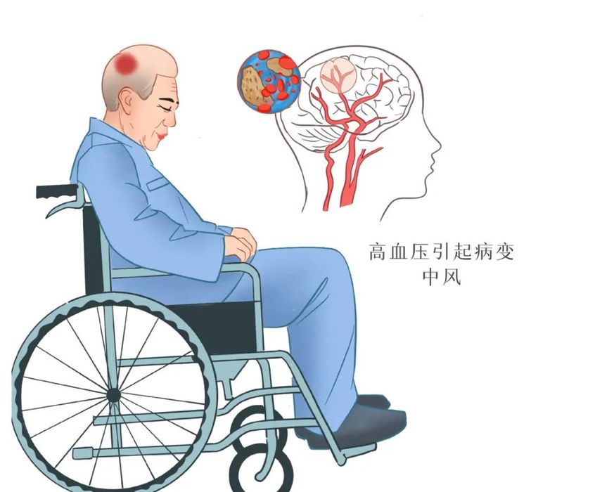 脑梗死患者如需接受高压氧治疗,需要注意什么 | 科普时间